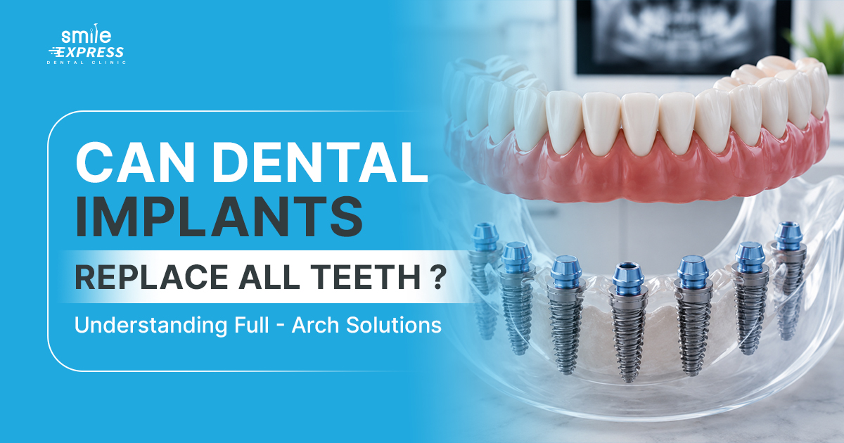Can Dental Implants replace all teeth