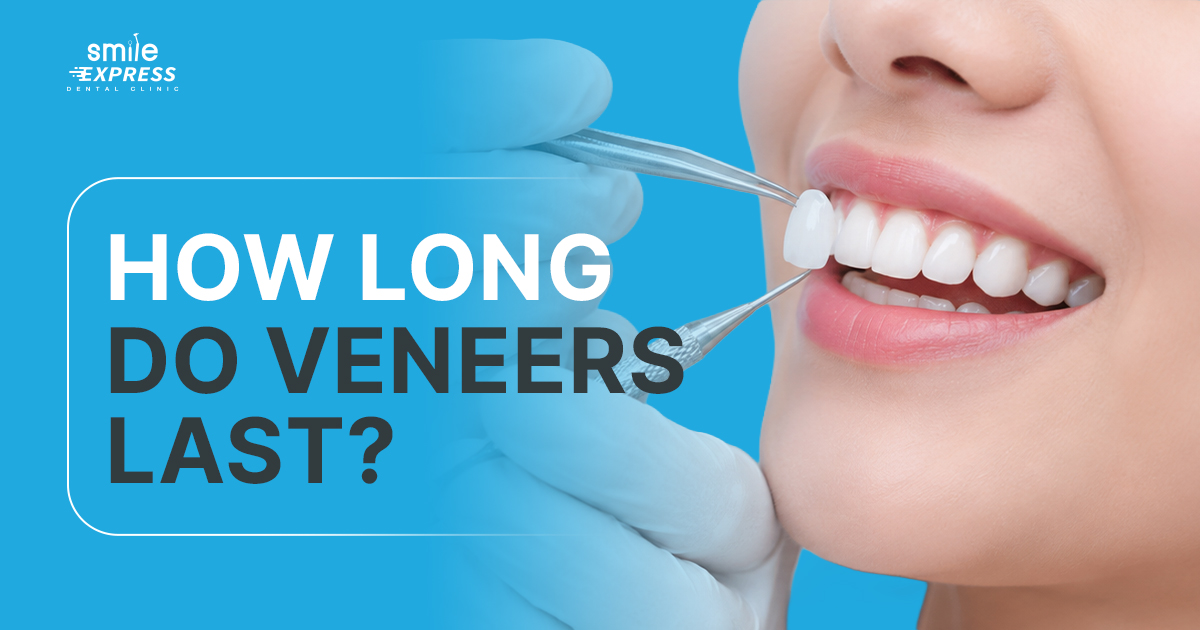 how long do veneers last?